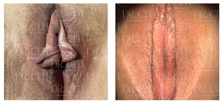 Doctor CEH - Labioplastía00002