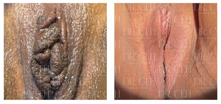 Doctor CEH - Labioplastía00003