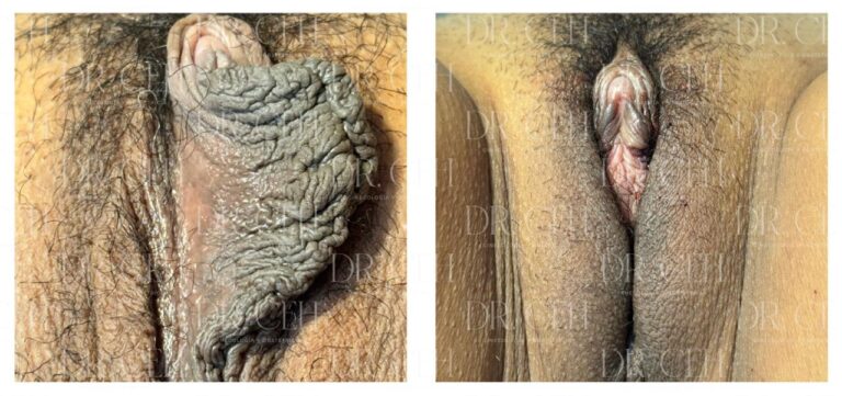 Doctor CEH - Labioplastía00004