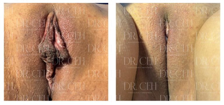 Doctor CEH - Labioplastía00005