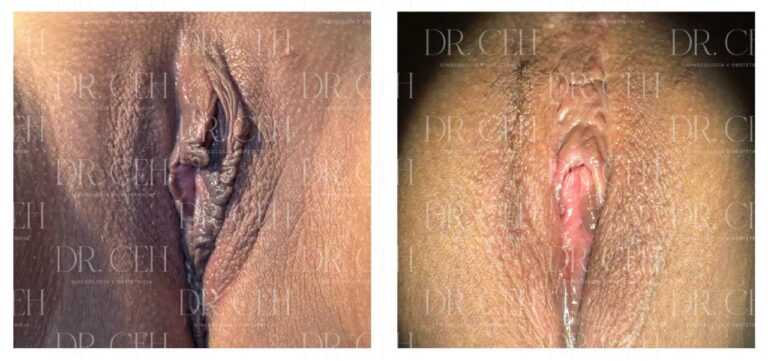 Doctor CEH - Labioplastía00006