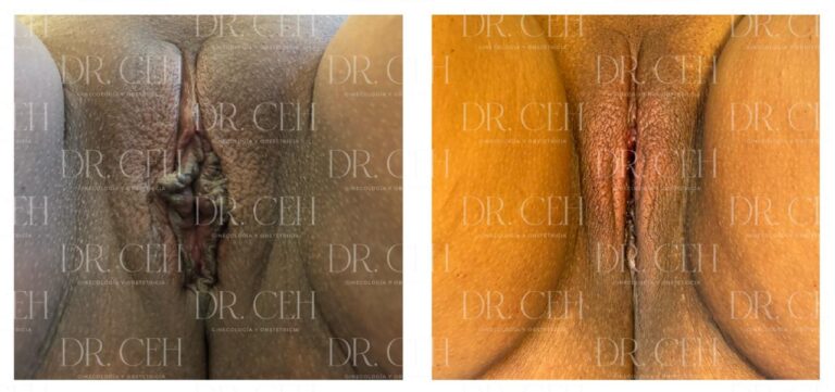 Doctor CEH - Labioplastía00007