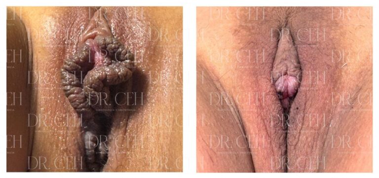 Doctor CEH - Labioplastía00008